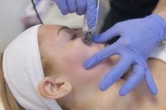 redmicroneedling4